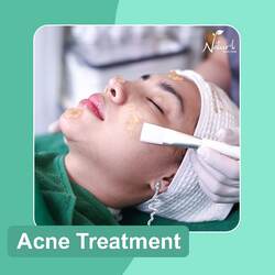 Acne Treatment (35min) / 1 Time