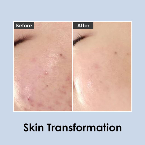 CENTALLA ACNE CREAM Medi-Peel Centella Mezzo Cream 30ml