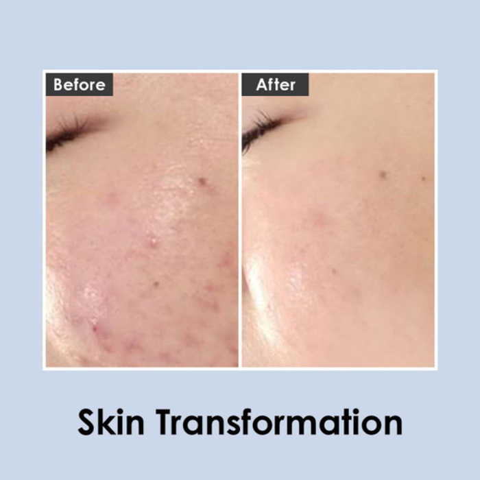 CENTALLA ACNE CREAM Medi-Peel Centella Mezzo Cream 30ml