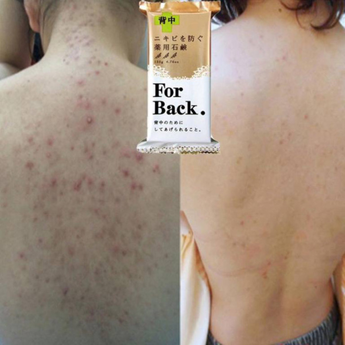 For Back Acne Soap 