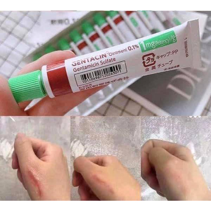 Scar Removal (Gentacin 0.1%) 