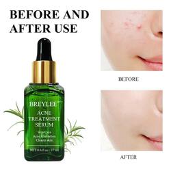 Serum សេរ៉ូមលាបមុខ ព្យាបាលមុខមុនស្នាម ស្បែកមុខតឹងណែនក្មេងជាងវ័យ