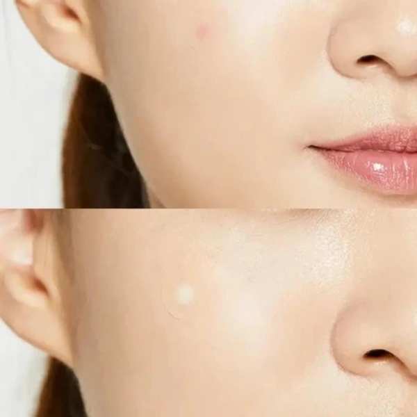 COSRX ACNE PIMPLE MASTER PATCH FAST ACTING