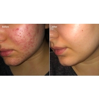 Dalacin T Gel 1% 10g