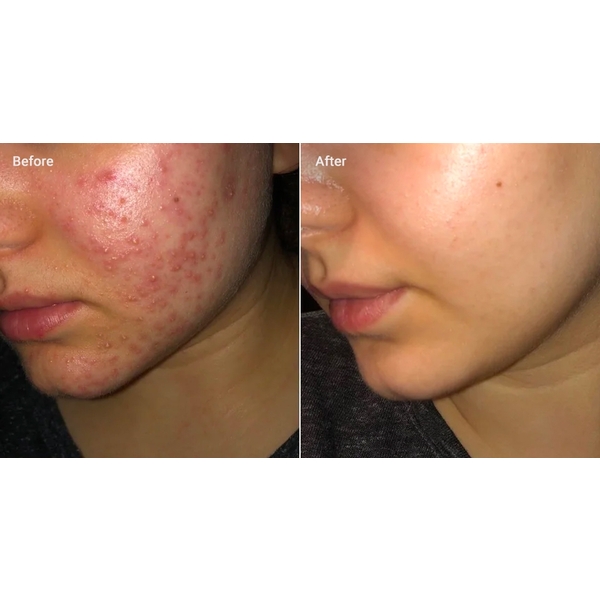 Dalacin T Gel 1% 10g