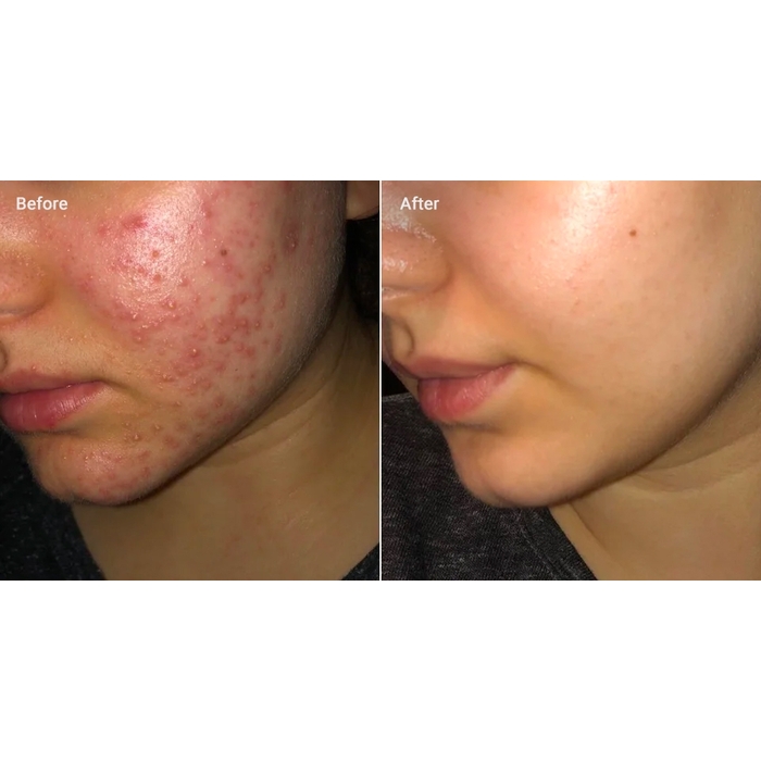 Dalacin T Gel 1% 10g