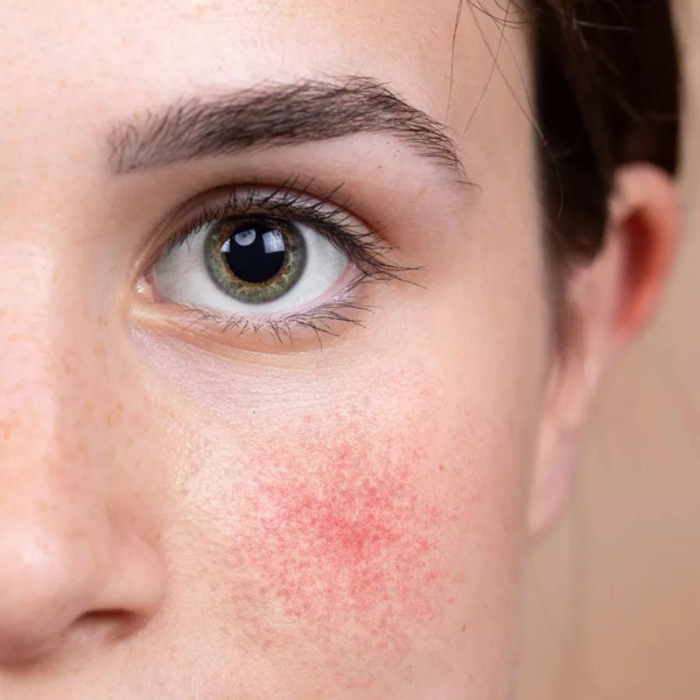 ISISPHRMA Ruboril lotion 